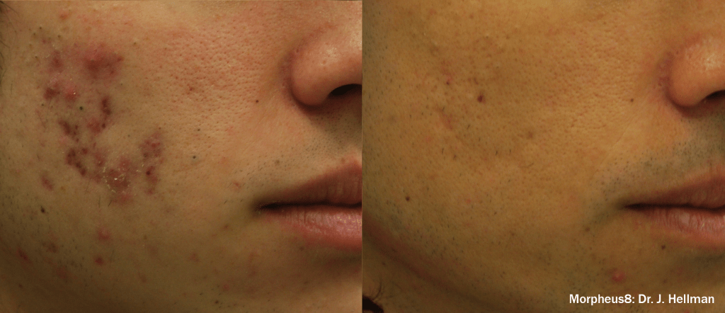 Morpheus8 Before and After Acne Treatment