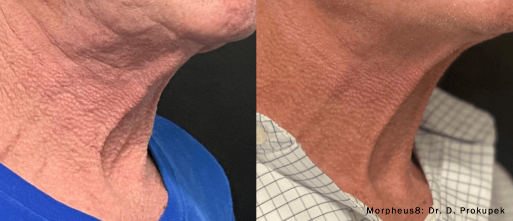 Morpheus8 Before and After Neck Wrinkle Treatment
