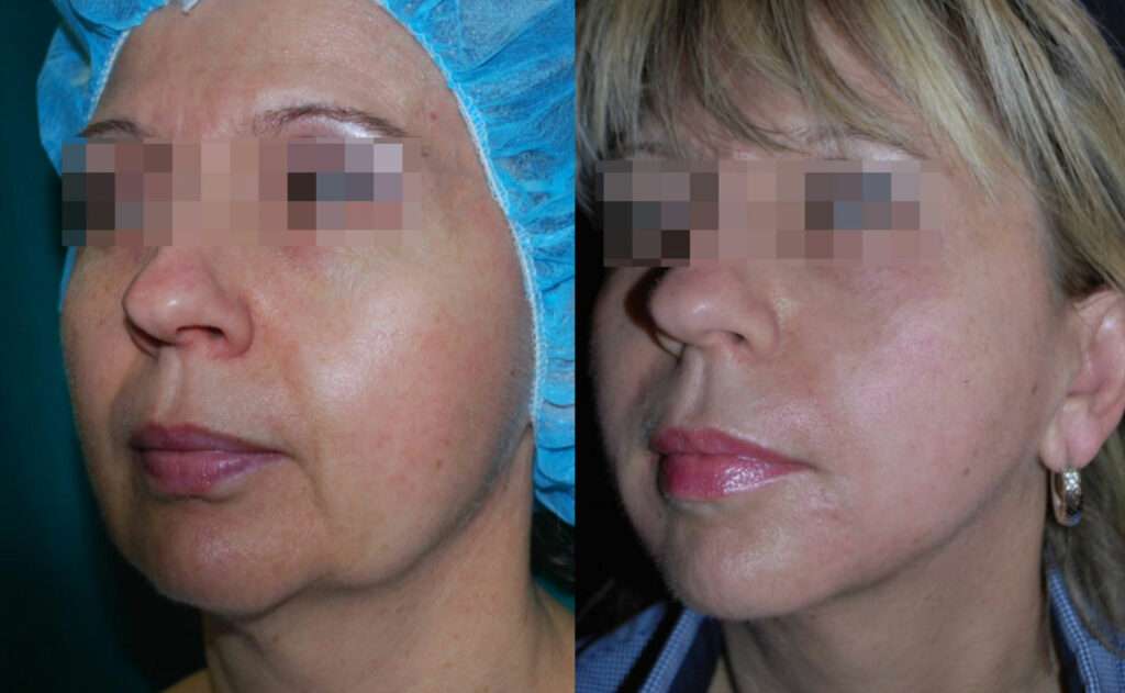 Morpheus8 face tightening treatment before and after