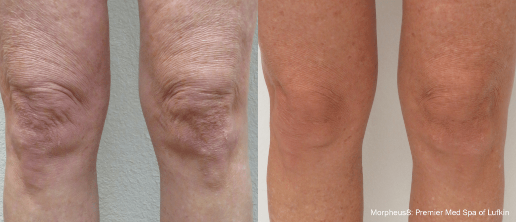 Morpheus8 leg tightening treatment before and after