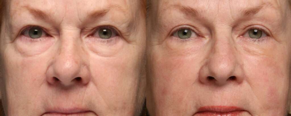 Morpheus8 skin tightening treatment before and after