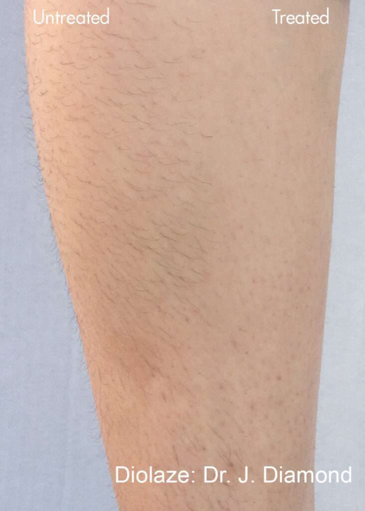 Comparison of a leg before and after Diolaze laser hair removal treatment with in Meridian, Idaho.