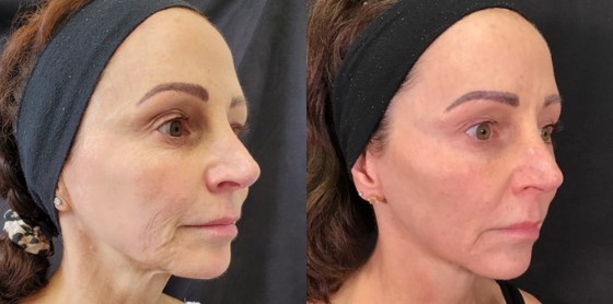 Side-by-side comparison of a woman's profile before and after a Morpheus8 treatment in Meridian.