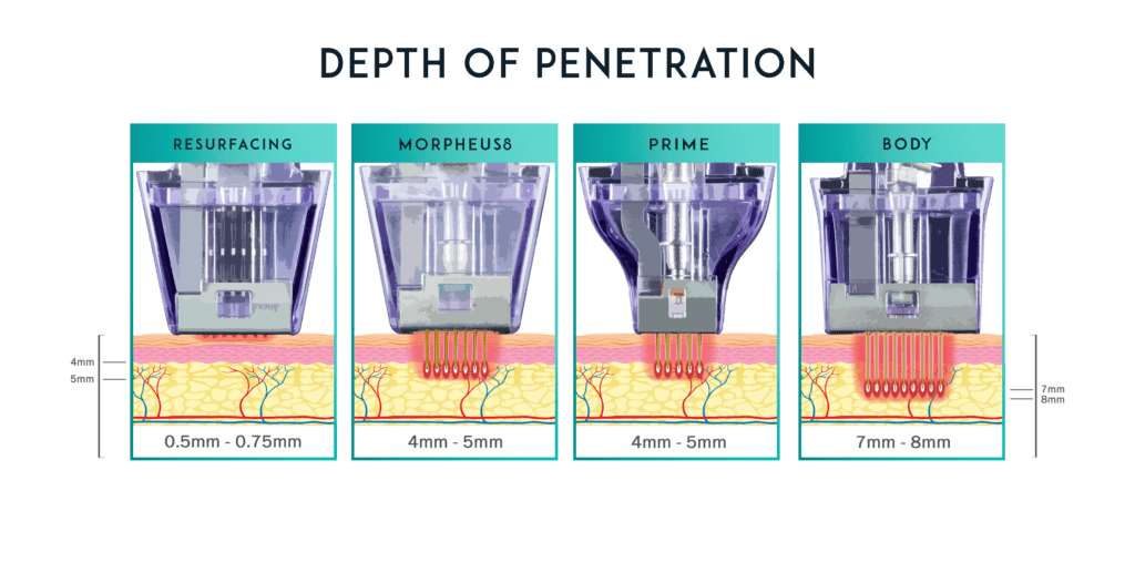 Illustration showing the treatment depths of Morpheus8 microneedling